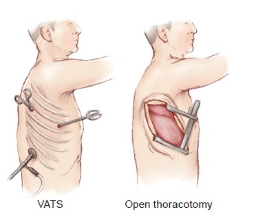 Benefits Of Minimally Invasive Thoracic Surgery