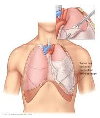 Decortication Of Lung