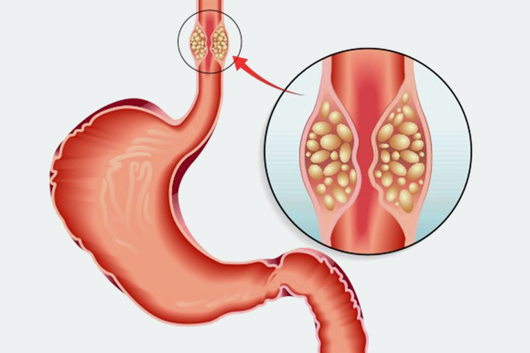 Esophageal Cancer Surgery