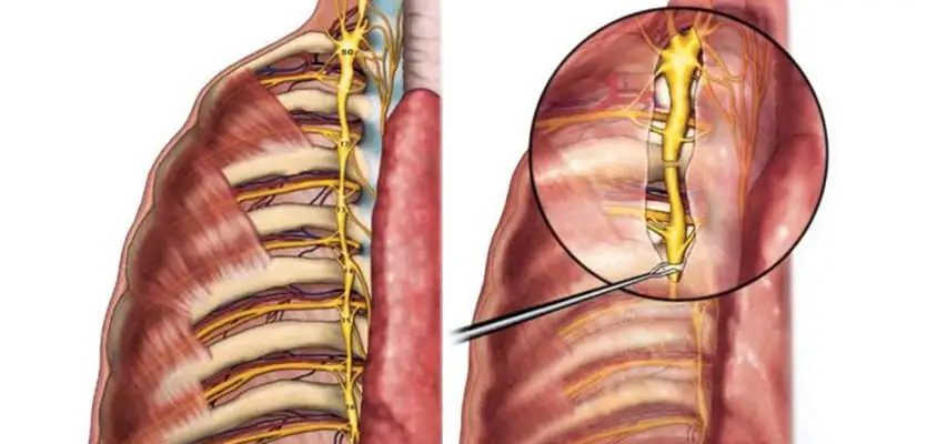 Hyperhidrosis Surgery