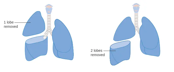 Lobectomy Procedure