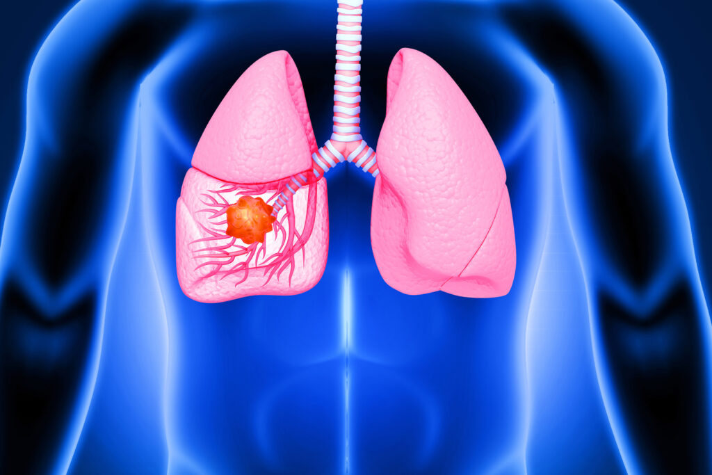 Lung Cancer Surgery