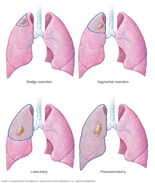 Lung Resection Surgery