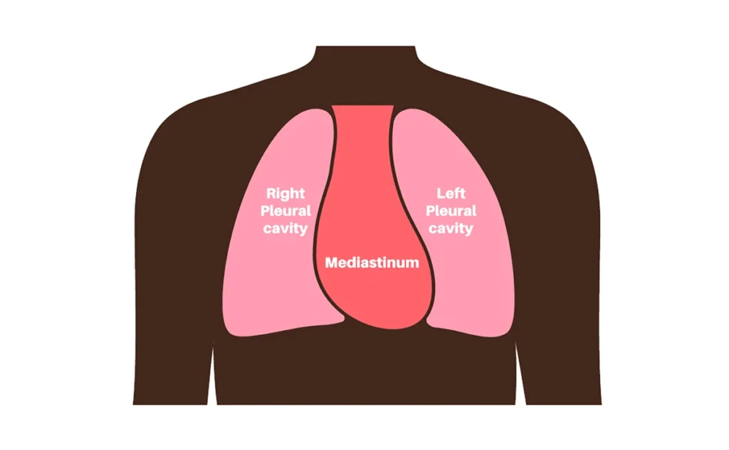 Mediastinal Tumor Surgery