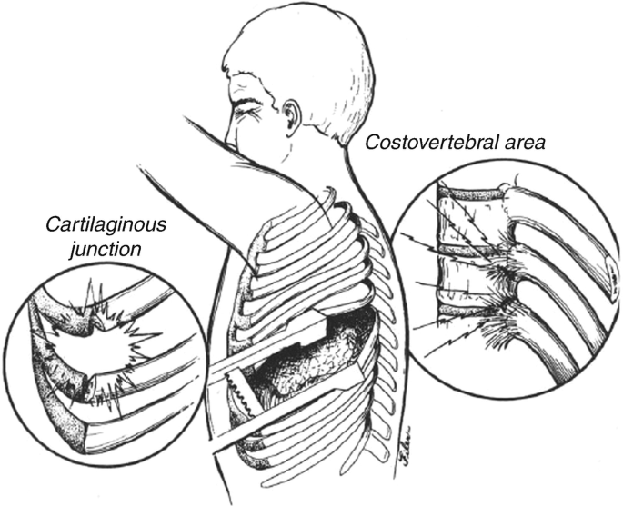 Pain Management After Thoracic Surgery