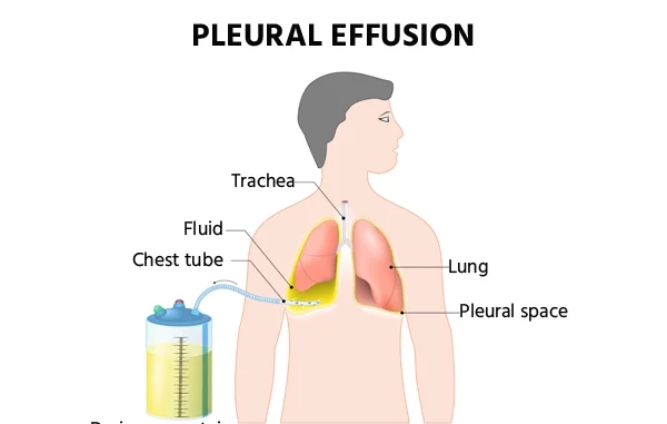 Pleural Effusion Treatment