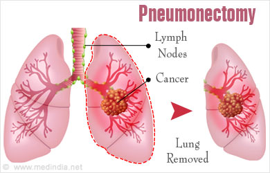 Pneumonectomy Surgery