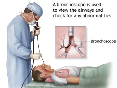 Pulmonary Nodule Removal