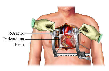 Surgery For Chest