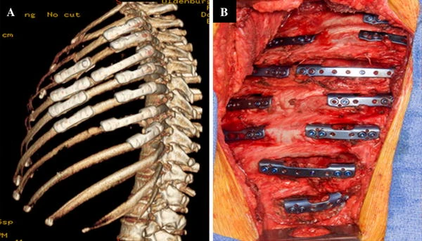 Surgery For Flail Chest