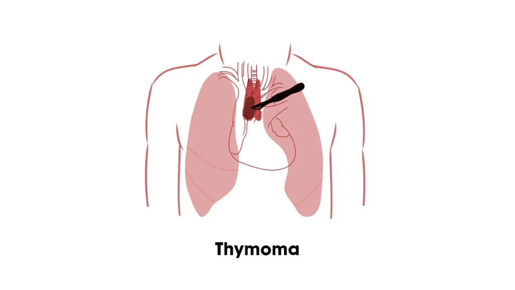 Surgery For Thymoma